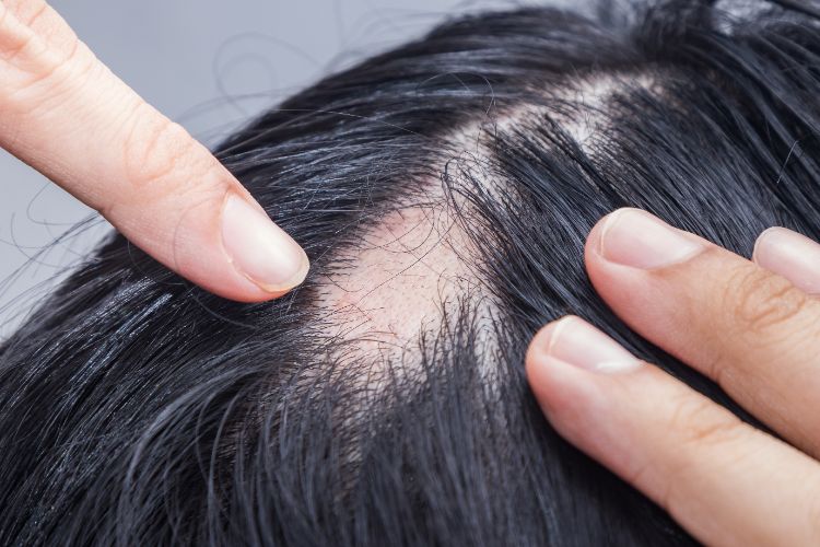 O que é alopecia?